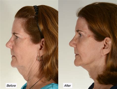 THE FACELIFT PROCEDURE INVOLVES SECURE INCISION AND RESHAPING A typical facelift procedure will involve an incision in front of, and behind the ear. . Facial plastic surgery charleston sc
